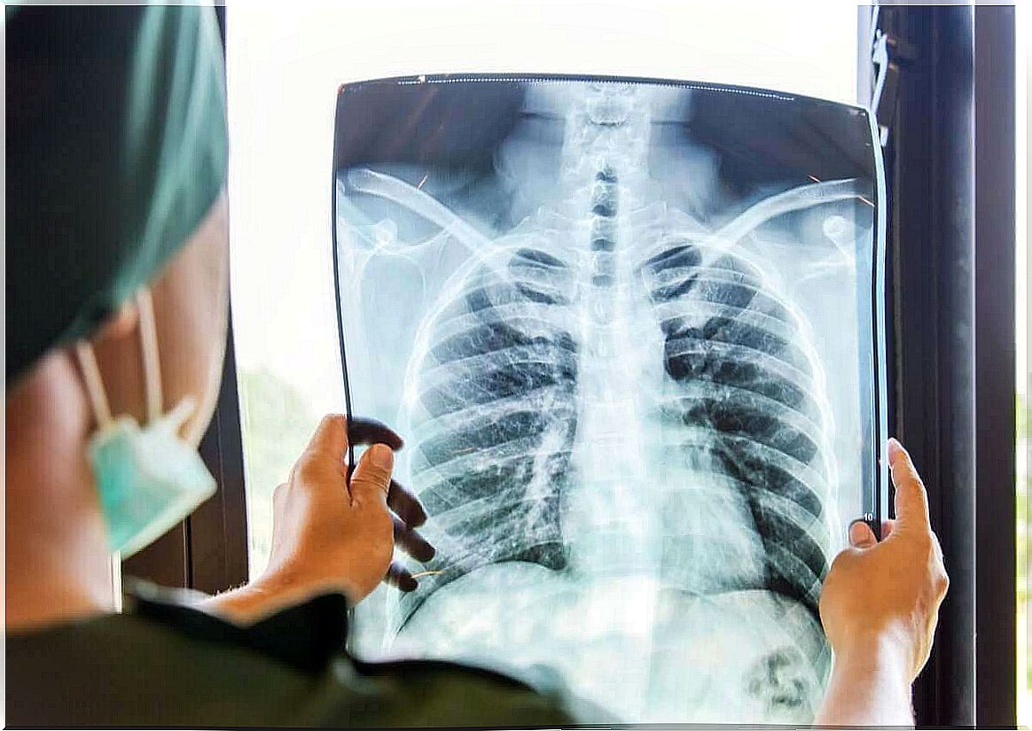 X-ray of the lungs