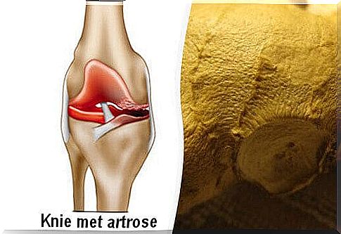 This is how you eliminate symptoms of osteoarthritis