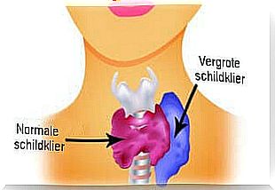 Hyperthyroidism in Women: Symptoms and Nutrition