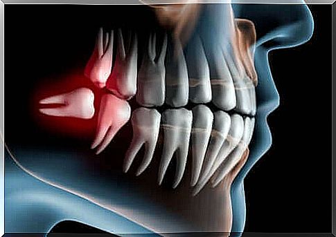 Impacted Wisdom Teeth: Symptoms and Treatment