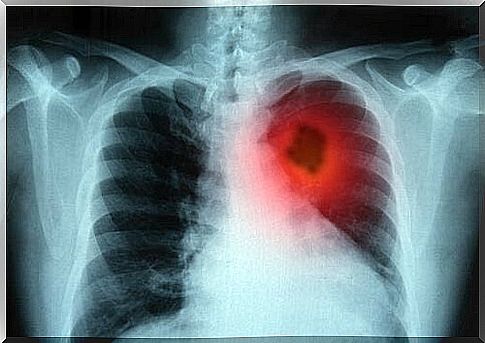 X-ray lung cancer