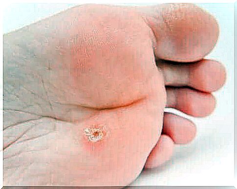 Plantar warts: features and treatment