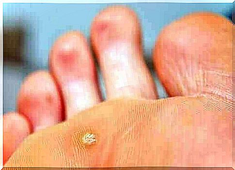 Diagnosis of Plantar Warts