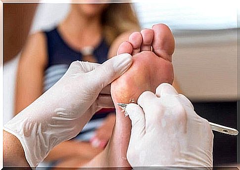 Remove warts on the foot