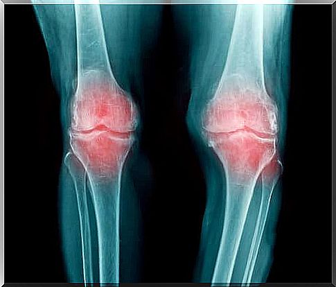 Preventing osteoarthritis in the knees