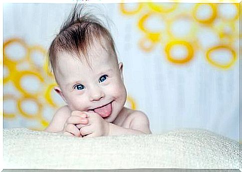 A baby with Down syndrome