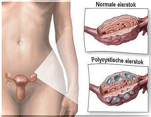 Remedies for Polycystic Ovarian Syndrome