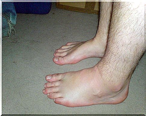 Natural diuretics for swollen feet