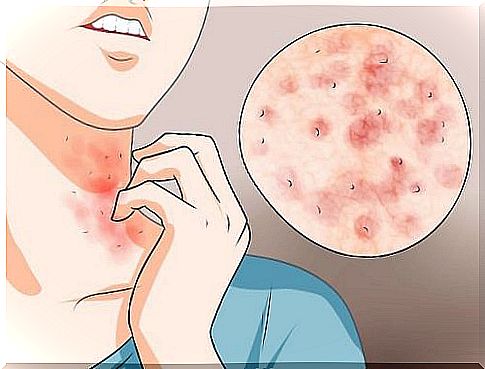 Three easy home remedies for scabies