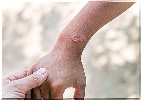 Why is it important to treat scabies?