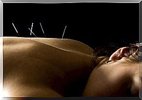 acupuncture