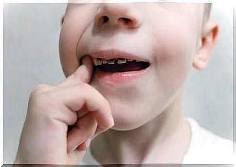 Child with cavities in the teeth