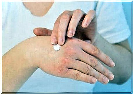 Person applying hand cream after bee sting